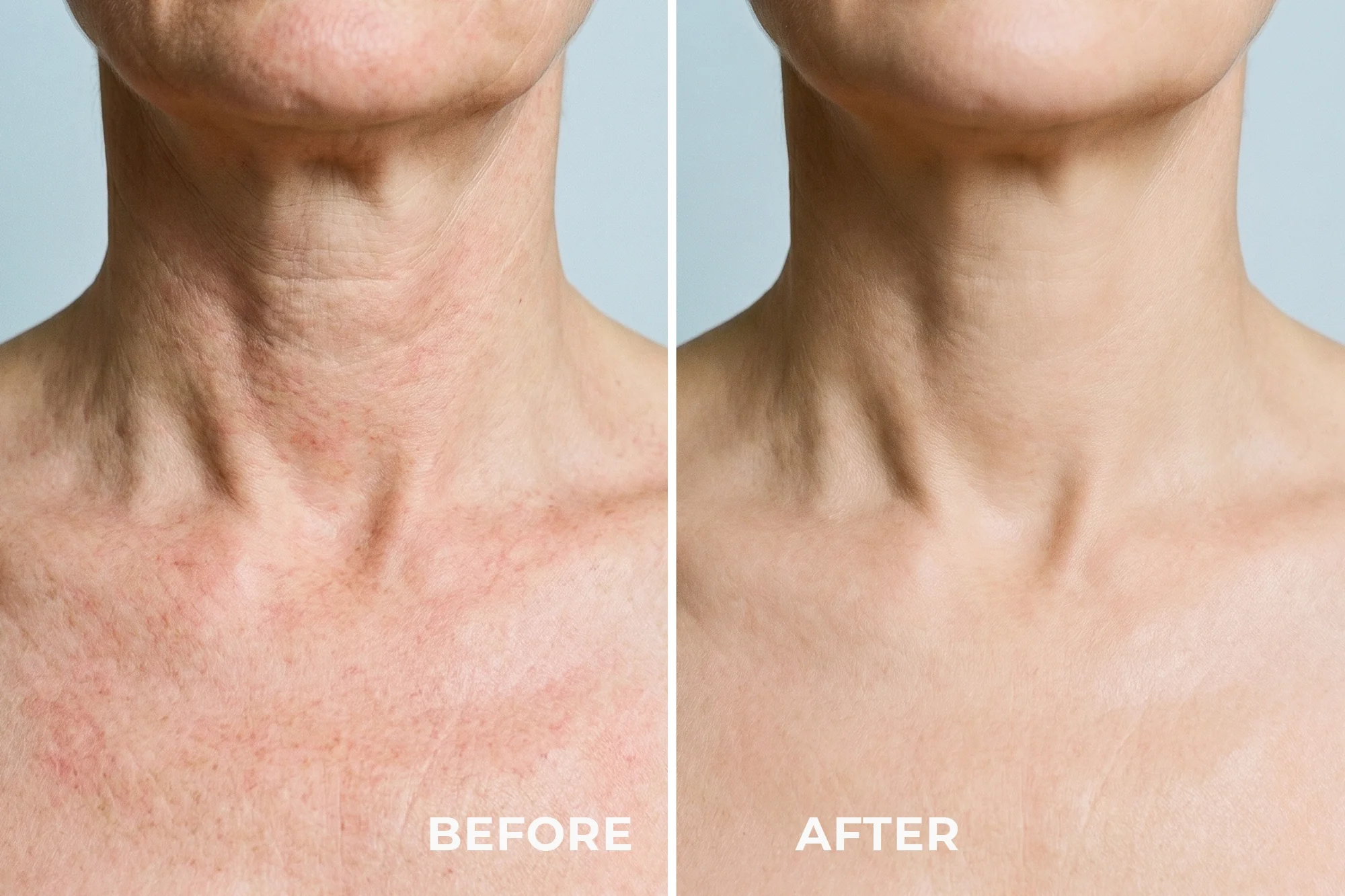 LED NECK MASK 2.0 - PHOTOTHERAPY MASK FOR THE NECK AND DECOLLETAGE AREA - Image 3
